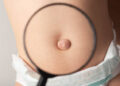 An umbilical hernia in a child on the stomach through a magnifying glass. Treatment of dilated umbilical ring, medical
