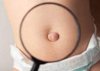 An umbilical hernia in a child on the stomach through a magnifying glass. Treatment of dilated umbilical ring, medical