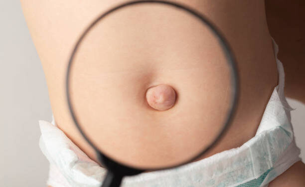 An umbilical hernia in a child on the stomach through a magnifying glass. Treatment of dilated umbilical ring, medical